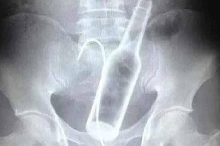 Homem é Operado Após Inserção de Garrafas no ânus