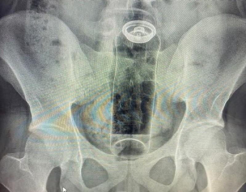 Jovem de 19 anos é internado após desodorante ficar preso no ânus