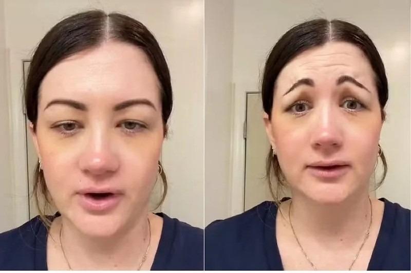 Botox dá errado e mulher fica com cara de “palhaço triste”