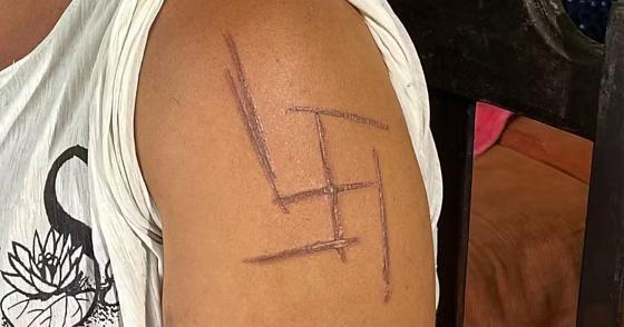 Mulher marcada com símbolo nazista relata tortura e diz que terá que remover a própria pele