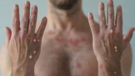 Variante da Mpox com Maior Transmissão Coloca Mato Grosso em Alerta Máximo