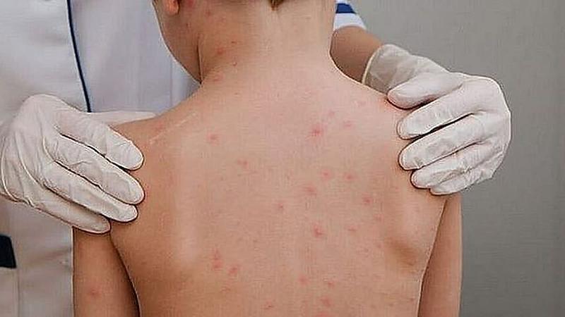 Alerta de Saúde em Sorriso (MT): 3º Caso de Meningite Infantil é Confirmado