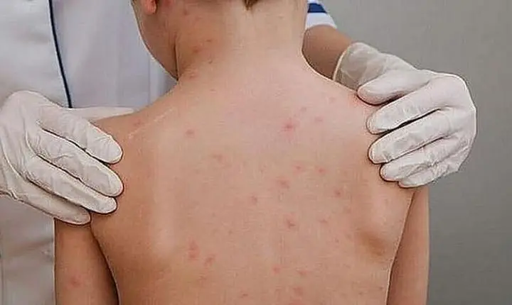 Alerta de Saúde em Sorriso (MT): 3º Caso de Meningite Infantil é Confirmado