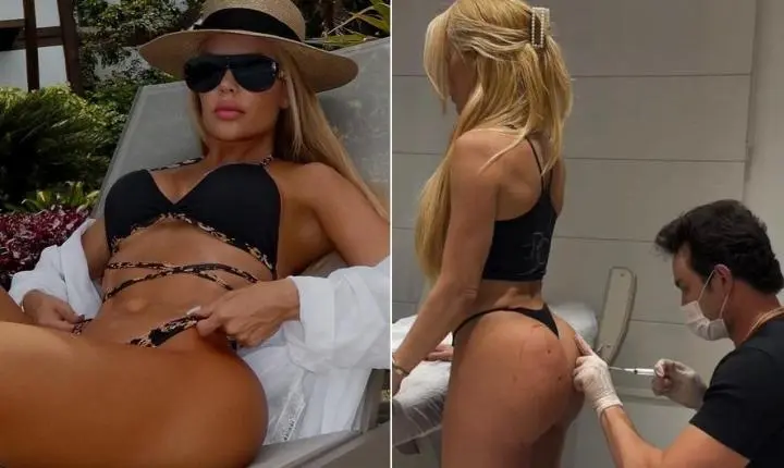 Denise Dias mostra antes e depois de procedimento no bumbum