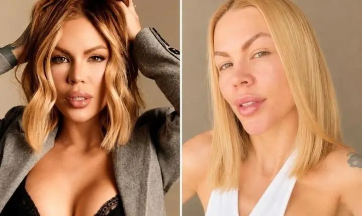 Influencer gasta mais de R$ 100 mil com reversão de procedimentos: 'Desfazer meu rosto'