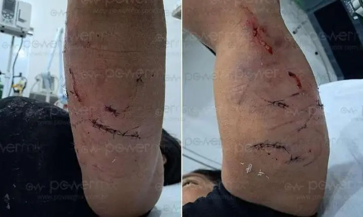 Mulher é atacada por cachorro ao tentar proteger pets e fica ferida em Nova Mutum